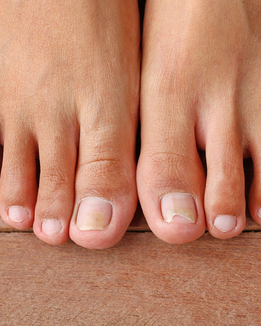Can Damaged Toenails Look Beautiful Again? Medical Pedicures, Nail Restoration & KeryFlex
