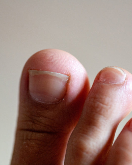 Why Won’t My Toenail Fungus Go Away? Understanding Stubborn Fungal Nails
